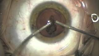 Cataract Surgery  Refractive Lens Exchange [upl. by Glendon]