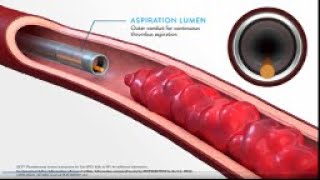 JETi Hydrodynamic Thrombectomy System Method of Action MOA Animation [upl. by Rissa]