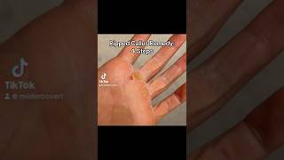 Ripped Callus Remedy ripped callustreatment callus hand remedy workout workhands cringe [upl. by Brill]