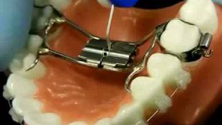 Bracesquestionscom  Orthodontic Jaw Expander How to Turn [upl. by Ehtyaf]