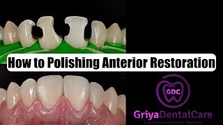 how to polishing anterior restoration composite [upl. by Tacklind]