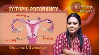 ECTOPIC PREGNANCY AND ITS MANAGEMENTSDHANYA DEEPUOBSTETRIC AND GYNECOLOGICAL NURSING [upl. by Sella]