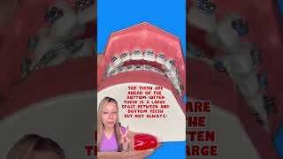 WHAT IS THE PERFECT BITE 👀 ORTHODONTIST EXPLAINS DIFFERENT TYPES OF TEETH PATTERNS shorts braces [upl. by Aimac]