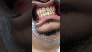 Ortho braces treatment before after result without extraction veneer beauty teethcleaning [upl. by Ofori]