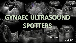 GYNAEC ULTRASOUND SPOTTERS  6 INTERESTING CASES  WITH ANSWERS [upl. by Supmart]