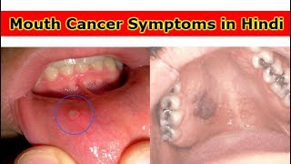 Mouth Cancer Symptoms and Treatment जानिए ओरल कैंसर से बचाव के तरीके [upl. by Zebapda]