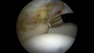 Treatment of PartiallyTorn Ligamentum Teres in Hip Arthroscopy [upl. by Nefen828]