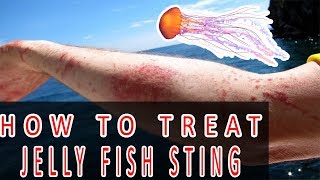 First Aid Treatment for Jellyfish Stings  How to Treat a Jellyfish Sting [upl. by Aloise]