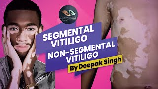 What is Difference between segmental and non segmental vitiligo   Deepak Singh Counselor [upl. by Floris]