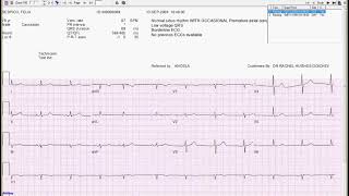 CPRS tips and tricks EKGs [upl. by Biles431]