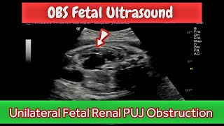 Fetal Renal PUJ obstruction  Obstetrical Ultrasound 32wks  what is treatment [upl. by Etaner]