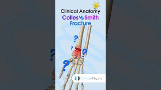 Colles vs Smith Fracture physicaltherapy physiotheraphy fracture wrist [upl. by Kcirdnekal762]