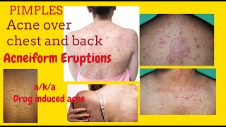 Pimples on chest and back or Acneiform Eruptions aka Drug induced acne  with Teratogenic Drugs [upl. by Hakeber940]