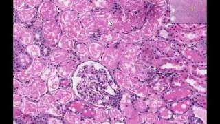 Histopathology Kidney Acute tubular necrosis [upl. by Pietje]