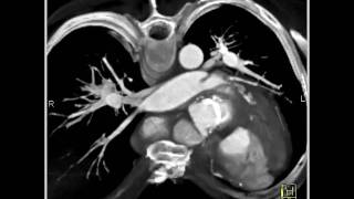 Cardiac Pseudoaneurysm of ascending aorta 1 of 5 [upl. by Latton959]