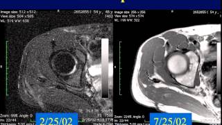 MRI of Soft Tissue Tumors  Pt1 [upl. by Shamrao]