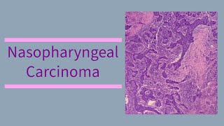 Nasopharyngeal carcinoma  etiology  pathology  diagnosis  management  EBV [upl. by Fortunio858]