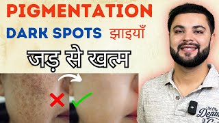 मुश्किल Pigmentation Dark Spots Melasma amp झाइयाँ जड़ से खत्म  100 Treatment [upl. by Inahpets]