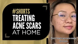 Treating Acne Scars at Home acnescars [upl. by Aem809]