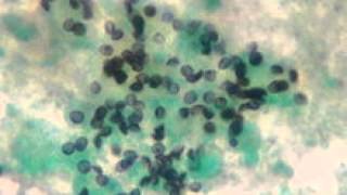 Pneumocystis pneumonia PCP [upl. by Annahsal]