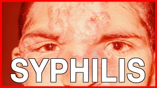 Signs and Symptoms of Syphilis Types of Syphilis and Treatment [upl. by Lazare851]