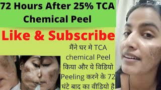 25 TCA Chemical Peel केमिकल पील करने के 72घंटे के बाद All Details Chemical peel [upl. by Ettennaj]