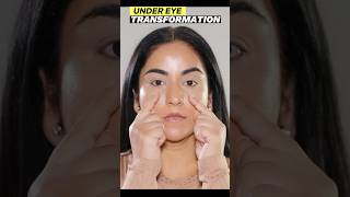 Transform YOUR Under Eye Hollow Instantly [upl. by Ulla]