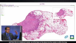 Lung Granulomas Caused by Fungal Infection [upl. by Pepin273]