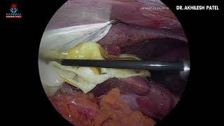 HYDATID CYST LIVER [upl. by Ybor510]