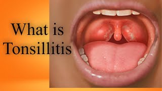 What is Tonsillitis Tonsils Kia hain Bachun me tonsils ka ilaj in UrduHindi [upl. by Eanyl679]