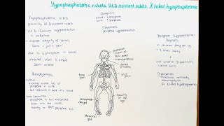 Hypophosphatemic Rickets Xlinked Hypophosphatemia Vitamin D resistant Rickets [upl. by Brandice]