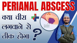 Perianal Abscess क्या चीरा लगवाने से ठीक होगा  Dr Anshul Shah PerianalAbscess fistulatreatment [upl. by Asena]