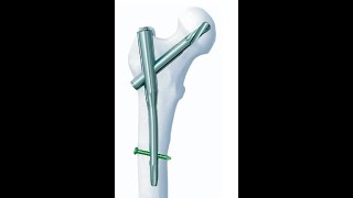 Proksimal femur çivisi  Proximal femoral nail [upl. by Trebuh]