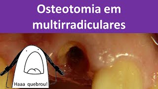 Osteotomia em multiradiculares Odontologia  Dra Bianca Rosa [upl. by Dnomyaw]