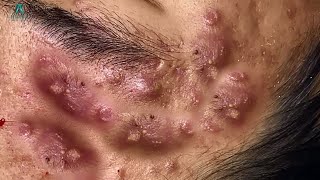 Big Cystic Acne Blackheads Extraction Blackheads amp Milia Whiteheads Removal Pimple Popping [upl. by Isabel783]