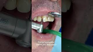 Tooth Decay Treatment [upl. by Deb]