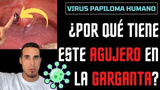 Increíble AGUJERO en la GARGANTA  Virus del PAPILOMA HUMANO [upl. by Saxon61]