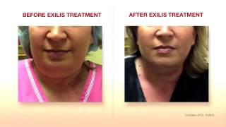 Exilis Elite Face Treatment Amara Clinic [upl. by Hekking]