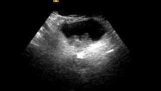 Urinary Bladder Mass  Differential Diagnosis [upl. by Lagasse336]