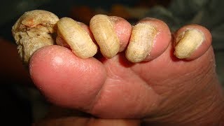 Home Remedies For Toenail Fungus That Work – CRUSH Nail Fungus Naturally [upl. by Fiester]