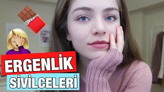 ERGENLİK SİVİLCELERİNİ YOK ETMEK [upl. by Salamone]