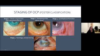 Cicatrizing Conjunctivitis דלקת לחמית מצלקת [upl. by Cummins]