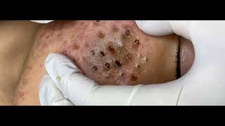 Big Cystic Acne Blackheads Extraction Blackheads amp Milia Whiteheads Removal Pimple Popping 0137 [upl. by Eitak365]