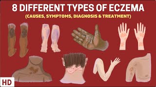 Eczema Exposed 8 Types You Need to Know [upl. by Ahseid]