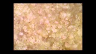 Scabies mites on skin crust [upl. by Cohbath249]