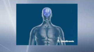 Deep Brain Stimulation  How does DBS work [upl. by Lahey]