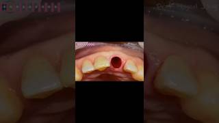 Implant placement Procedure [upl. by Onibag]