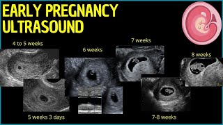 Early Pregnancy Ultrasound A Deep Dive into First Trimester Insights pregnancyultrasound [upl. by Ferino]