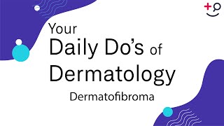 Dermatofibroma  Daily Dos of Dermatology [upl. by Sielen]