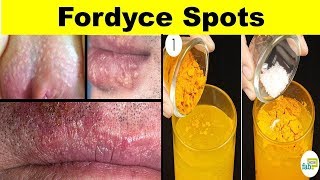 How to get ride Fordyce Spots  Treatments with natural Home Remedies 2018 [upl. by Rakso]